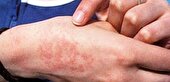 حیوان گزیدگی در البرز به ۱۵ هزار مورد در سال ۱۴۰۲ رسیده است