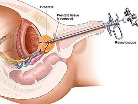 ببینید ا  روشی نوآورانه برای عمل پروستات