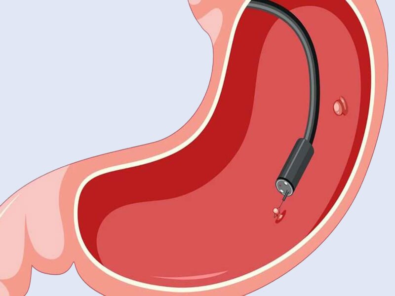 تفاوت عمل اسلیو معده و بوتاکس معده در چیست؟