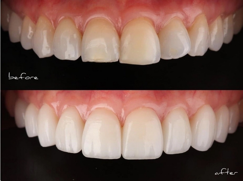 قبل و بعد از انجام لمینت دندان