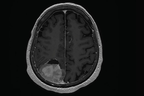 تومور | از شناخت انواع و تشخیص تا انتخاب بهترین جراح