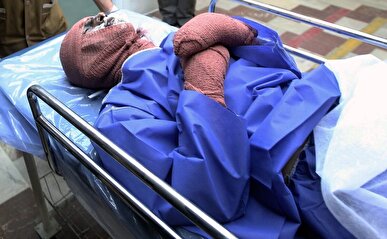 سوختگی در ایران ۸ برابر  متوسط جهانی است