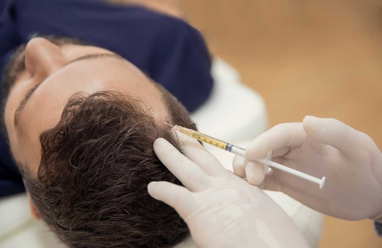 مقایسه قیمت پی آر پی مو و مزوتراپی مو