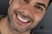 لمینت یا کامپوزیت؟ مقایسه کامل + راهنمای نهایی انتخاب