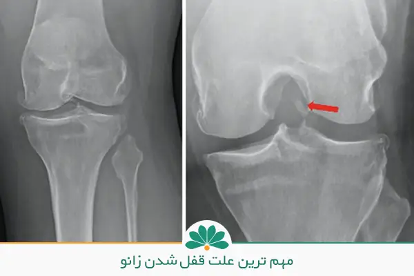درمان خانگی قفل شدن زانو | بهترین تکنیک ها و حرکات ورزش برای زانو درد