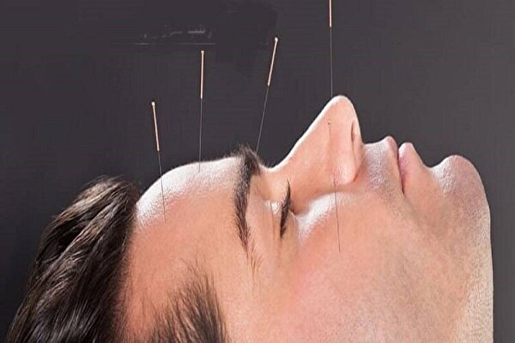 مشهد، قطب طب سوزنی کشور است