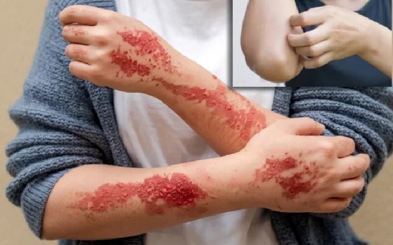 آلرژی به نیش حشرات؛ مشکلی پنهان اما جدی!