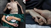سوء تغذیه در غزه از ۹۰ درصد فراتر رفته است