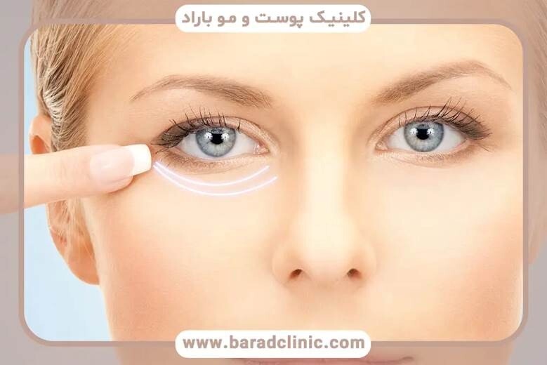 چشم‌های جوان‌تر با یک تکنولوژی نوین: تجربه بلفاروپلاستی با لیزر