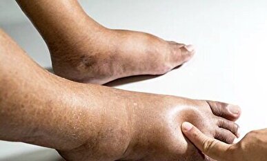 ورم ناگهانی پا را جدی بگیرید