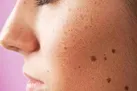 تکنیک های طلایی برای حذف لکه‌ های قهوه‌ای پوست
