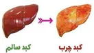 آنچه که درباره کبد چرب باید بدانیم