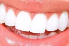 سفیدکننده های دندان برا چه کسانی خوب نیست؟