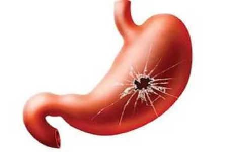 زخم معده چه زمانی ایجاد می‌شود؟