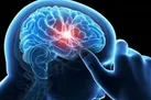 استفاده از نرم افزار برای تشخیص خونریزی مغزی