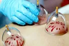 حجامت کنید تا عمر بیشتری داشته باشید!