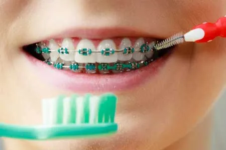 نکات طلایی برای مراقبت‌های بعد از ارتودنسی
