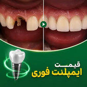 قیمت ایمپلنت فوری و هزینه کاشت دندان جلو در 1405