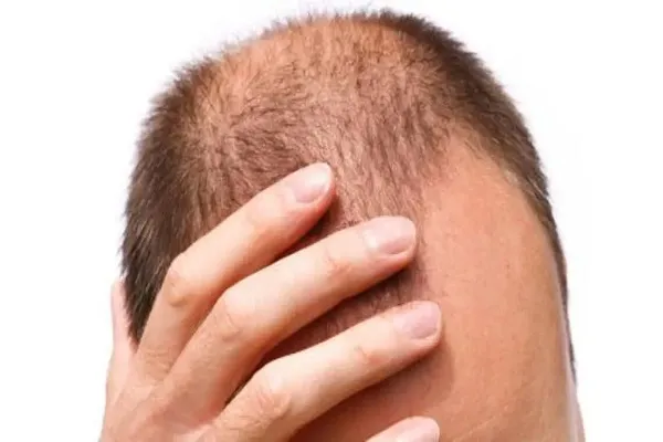 تمام توجیه‌های علمی برای ریزش دائمی موها!