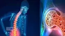 پیشگیری از پوکی استخوان با اصلاح عادت‌ غذایی