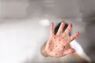 زنگ‌خطر سرخک