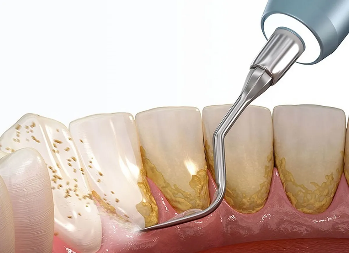 چرا جرمگیری دندان برای سلامت دندان‌ها ضروری است؟