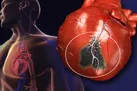 علائمی که نشان دهنده وقوع سکته قلبی است