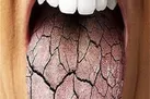 چرا دهانم خشک می شود؟
