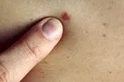 پوست روشن مستعد سرطان است