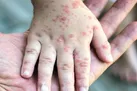 دوره پنهان سرخک ۲ هفته است / علائم بیماری با تب ظاهر می شود