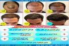 آیا نتایج کاشت مو دائمی است؟