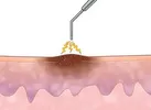 اثر پلاسما در بهبود زخم