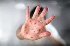هشدار در خصوص بیماری سرخک