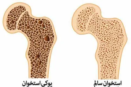 سالانه بیش از ۴هزار مرگ بر اثر پوکی استخوان / لزوم تامین لبنیات برای دهک‌های پایین توسط دولت