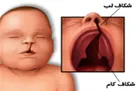 عوامل موثر در به وجود آمدن شکاف کام کدام هستند؟ / اختلال در یادگیری؛ نتیجه درمان نشدن عارضه لب شکری