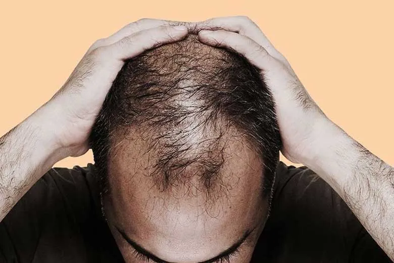 با خوردن این غذاها دیگر مو‌های تان نمی ریزد!