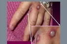 کدام افراد بیشتر در معرض ابتلا به آبله میمون هستند؟