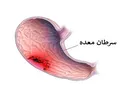 سرطان‌های دستگاه گوارش قابل پیشگیری هستند