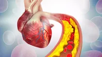 هوش مصنوعی می‌تواند به تشخیص بیماری تصلب شرائین کمک کند؟