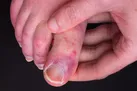 تاثیر کرونا بر روی انگشتان پا چگونه است؟