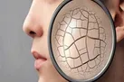 خشکی پوست پاییزی را چگونه درمان کنیم؟