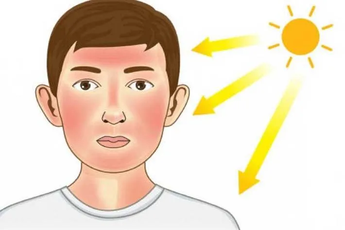 کار‌هایی که پس از ابتلا به آفتاب سوختگی نباید انجام داد