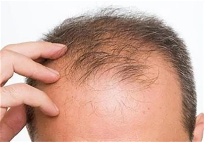 چگونه با استفاده از قهوه مانع ریزش موی خود شویم؟