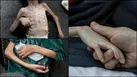 درمان یک کودک دچار سوءتغذیه در غزه هفته‌ها زمان نیاز دارد