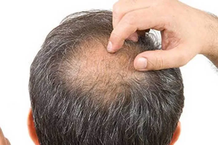 ریزش شدید مو از علائم عفونت کرونا / تغییر روزانه علائم بالینی بیماری