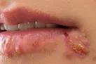 روشی جدید که تبخال را فورا از بین می برد