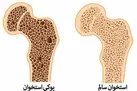سالانه بیش از ۴هزار مرگ بر اثر پوکی استخوان / لزوم تامین لبنیات برای دهک‌های پایین توسط دولت