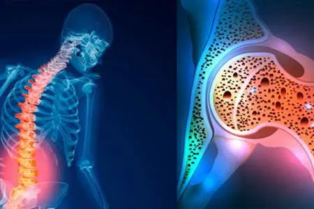 شیوع بالای پوکی استخوان در سنین بالای 50/ کمبود جدی ویتامین D