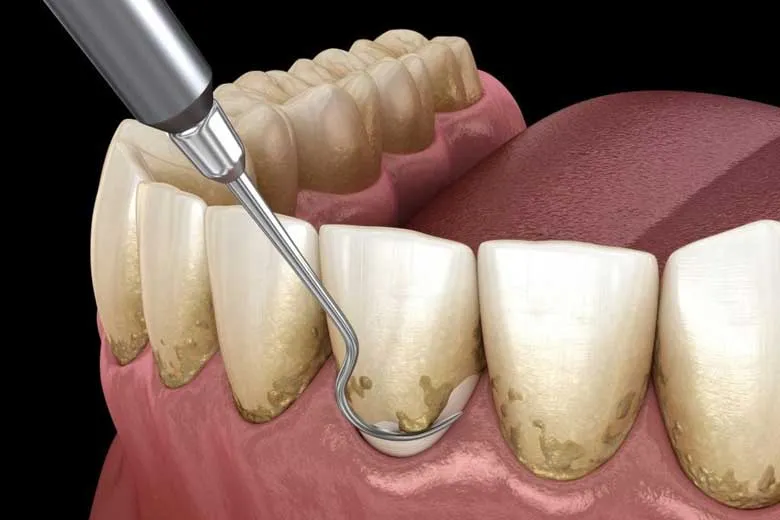 چرا جرمگیری دندان‌ ها مفید است؟