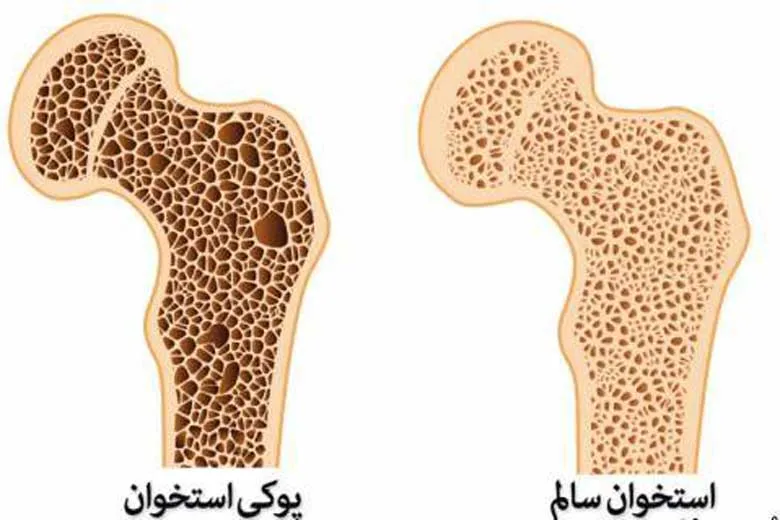 علت پوکی استخوان چیست؟